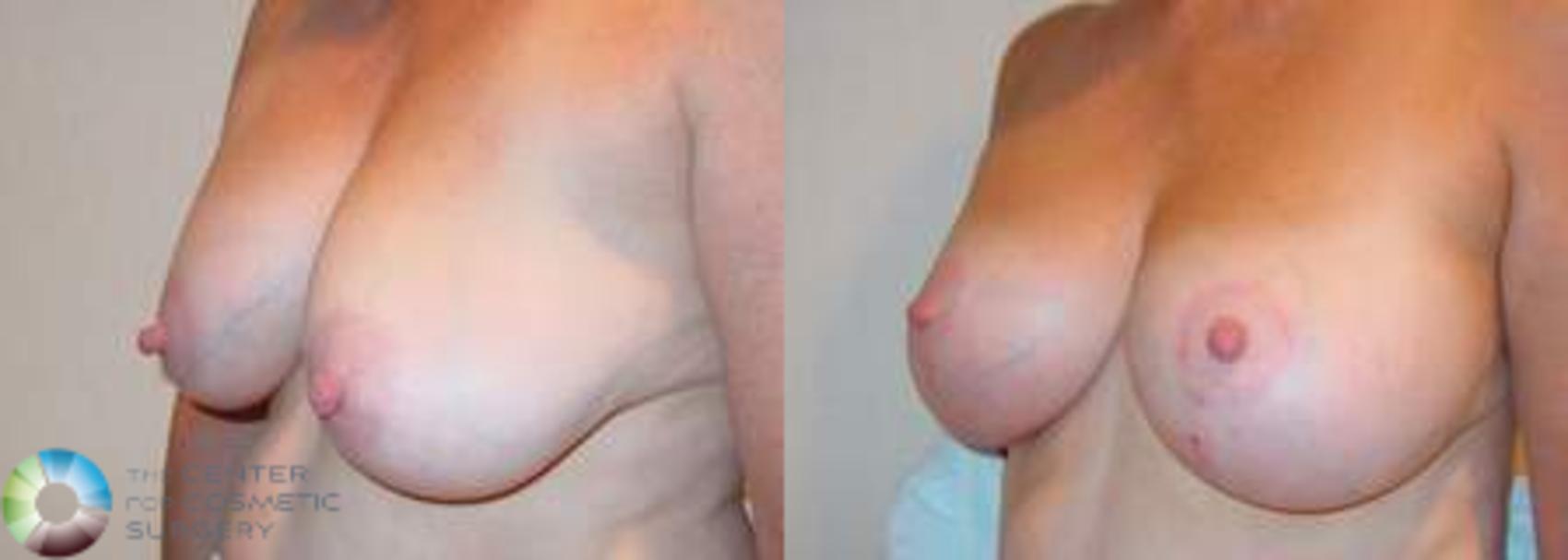 Before & After Breast Implant Revision Case 626 View #2 View in Golden, CO