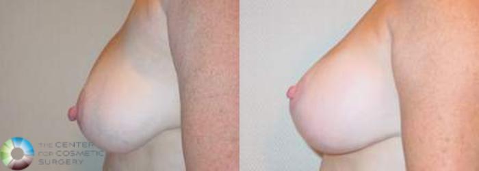 Before & After Breast Implant Revision Case 626 View #3 View in Golden, CO