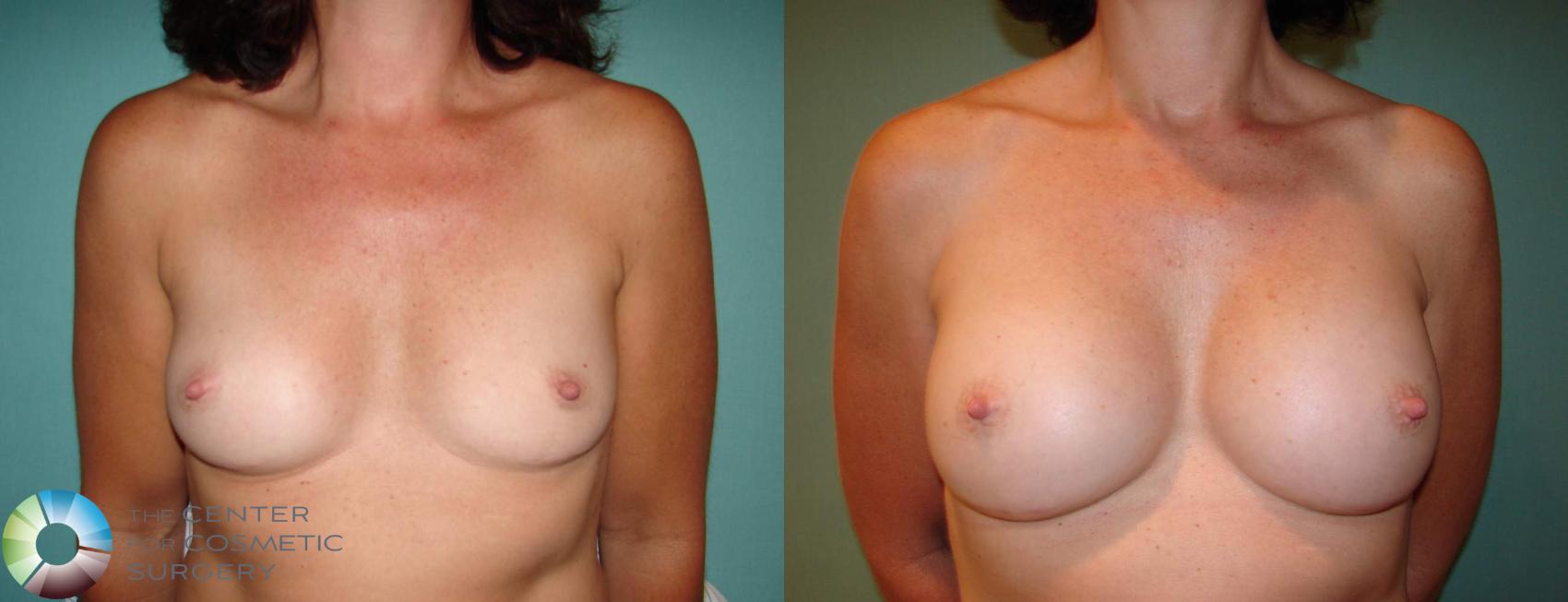 Before & After Breast Augmentation Case 627 View #1 in Denver, CO