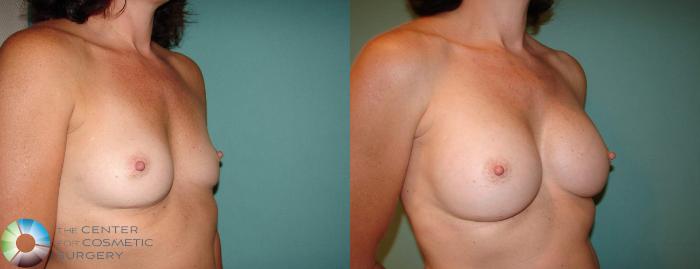 Before & After Breast Augmentation Case 627 View #2 in Denver, CO