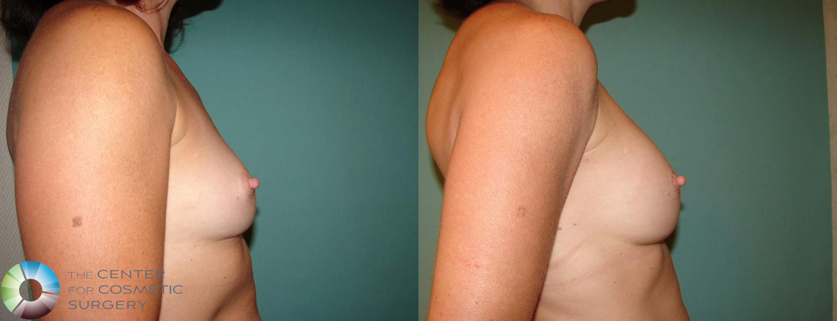 Before & After Breast Implant Revision Case 627 View #3 in Denver and Colorado Springs, CO