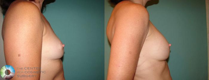 Before & After Breast Implant Revision Case 627 View #3 in Denver, CO