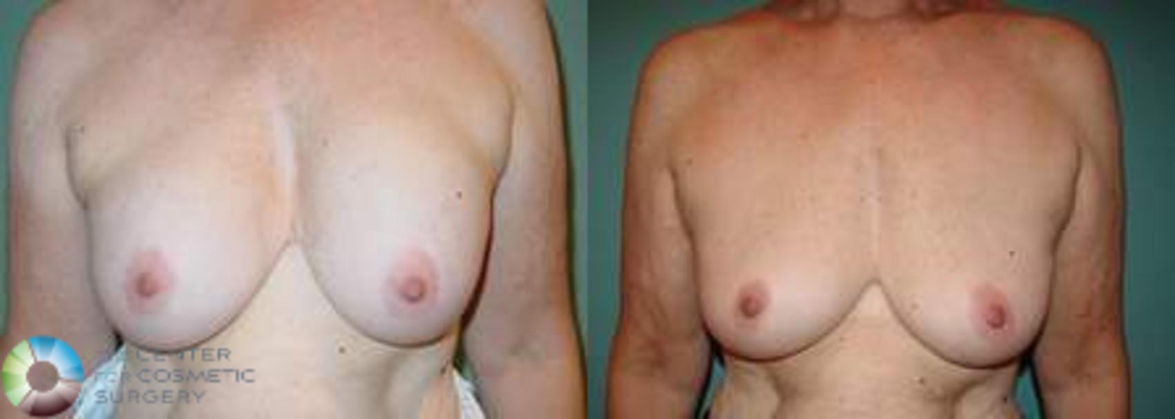 Before & After Breast Implant Removal (Explant) Case 629 View #1 in Denver and Colorado Springs, CO