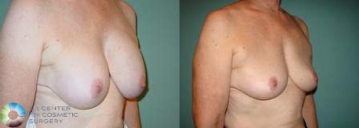 Before & After Breast Implant Revision Case 629 View #2 View in Golden, CO