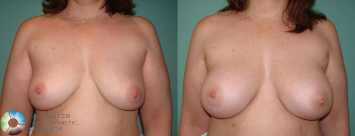Before & After Breast Implant Revision Case 634 View #1 in Denver, CO
