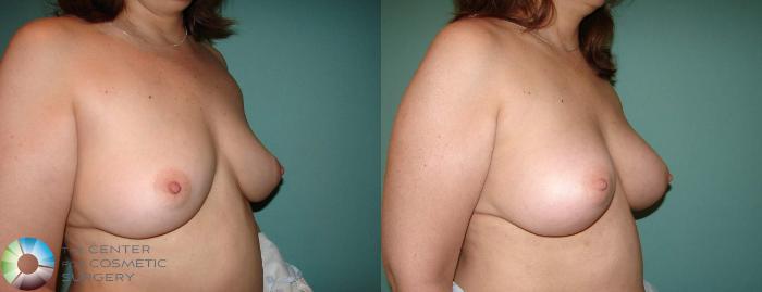 Before & After Breast Implant Revision Case 634 View #2 in Denver, CO