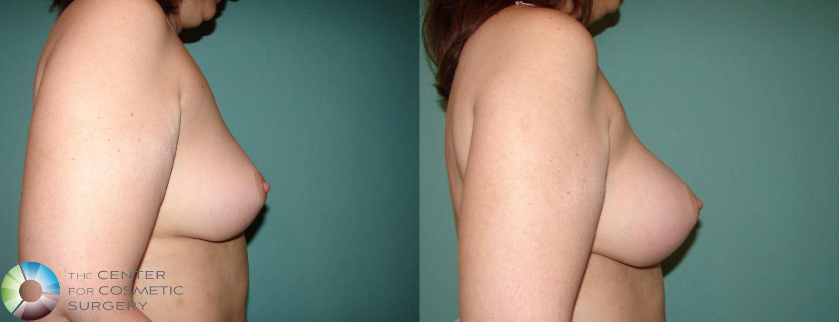 Before & After Breast Implant Revision Case 634 View #3 View in Golden, CO