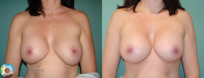 Before & After Breast Implant Revision Case 656 View #1 in Denver and Colorado Springs, CO