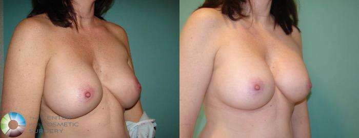 Before & After Breast Implant Revision Case 656 View #2 in Denver, CO