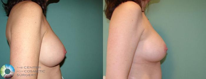 Before & After Breast Implant Revision Case 656 View #3 in Denver, CO