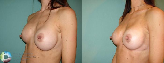 Before & After Breast Implant Revision Case 657 View #2 in Denver and Colorado Springs, CO
