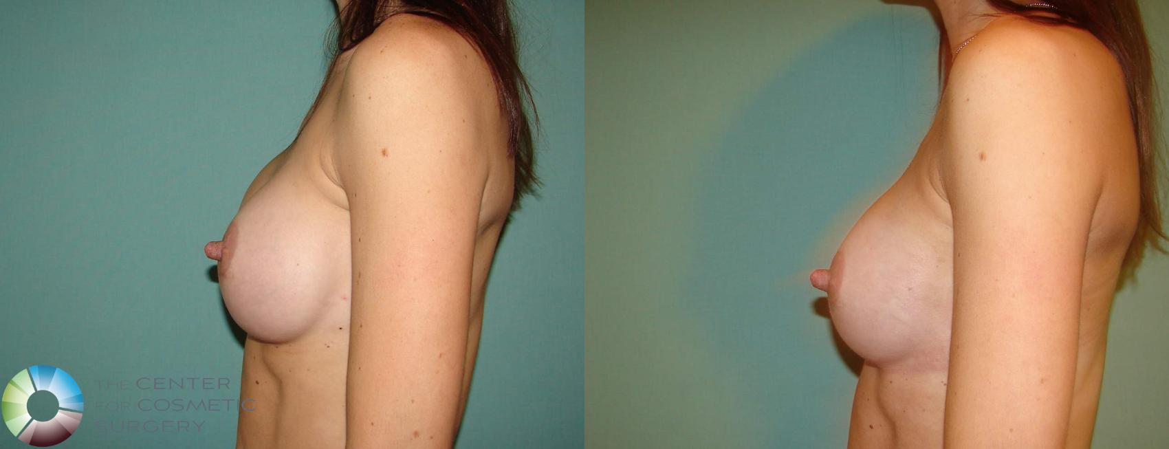 Before & After Breast Implant Revision Case 657 View #3 View in Golden, CO