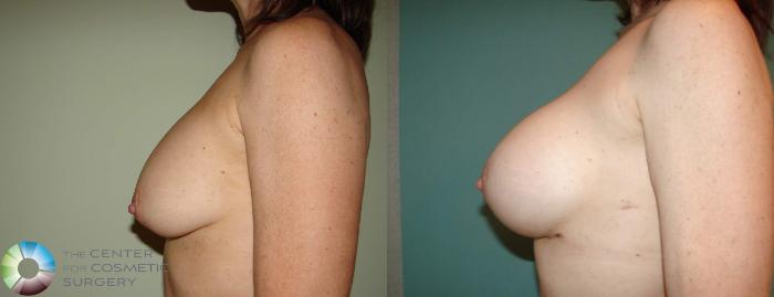 Before & After Breast Implant Revision Case 662 View #3 View in Golden, CO