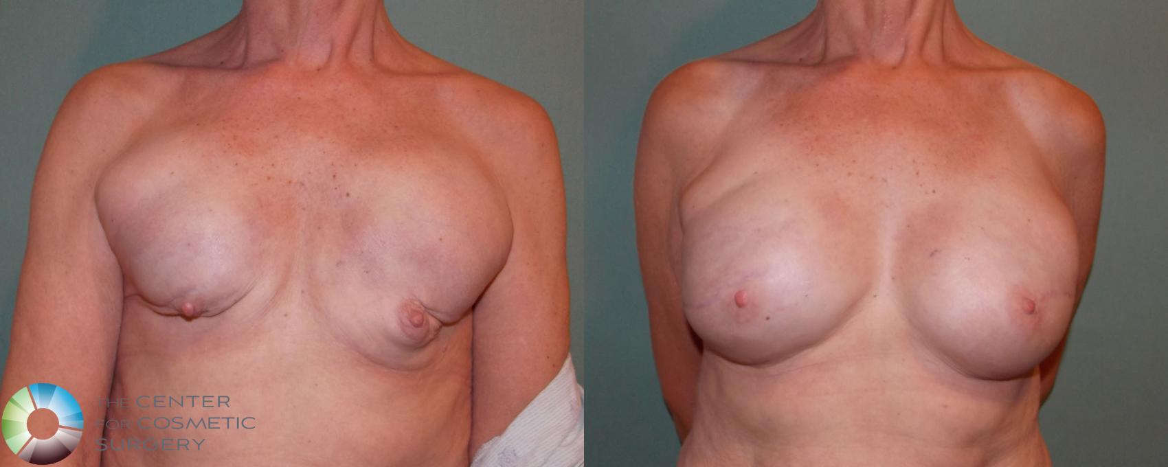 Before & After Breast Implant Revision Case 688 View #1 in Denver and Colorado Springs, CO