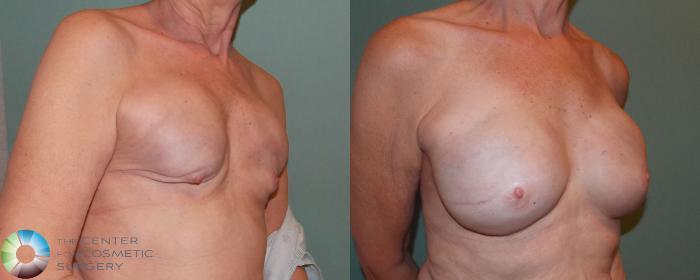 Before & After Breast Implant Revision Case 688 View #2 View in Golden, CO
