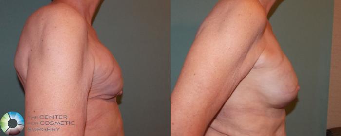 Before & After Breast Implant Revision Case 688 View #3 View in Golden, CO