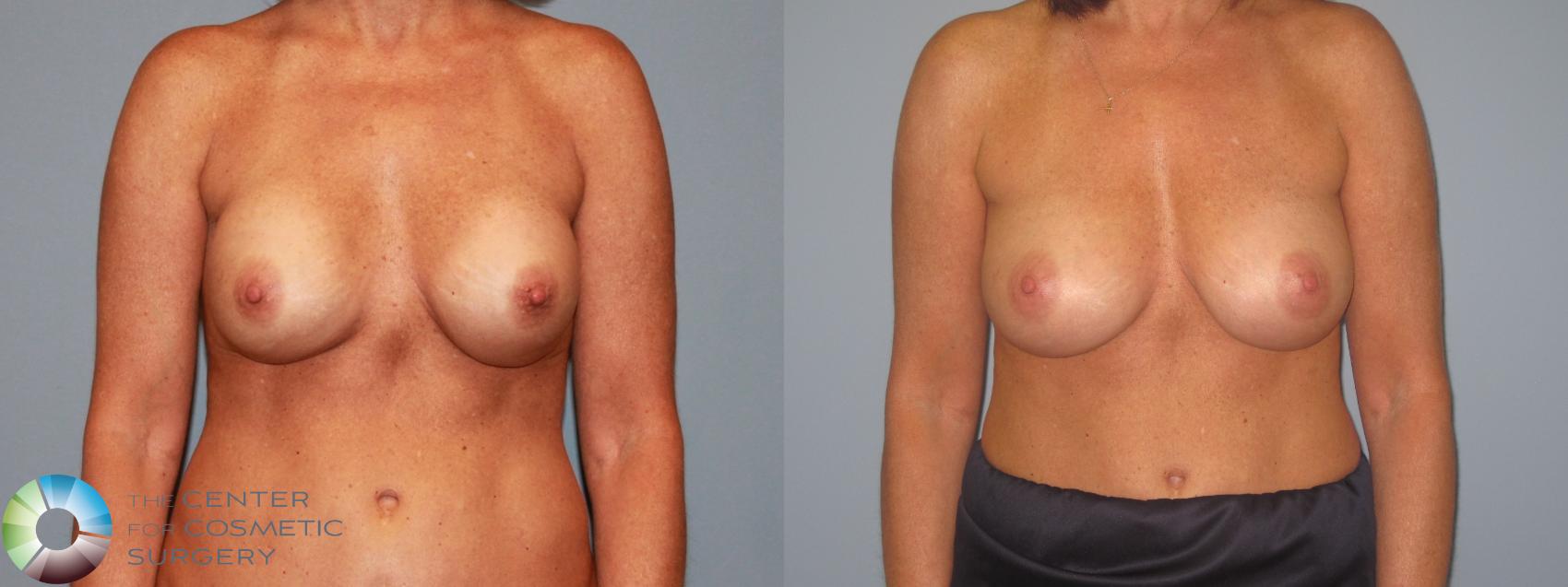 Before & After Breast Implant Revision Case 713 View #2 View in Golden, CO