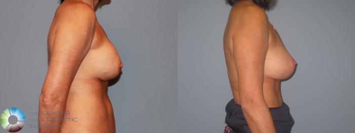 Before & After Breast Implant Revision Case 713 View #3 View in Golden, CO