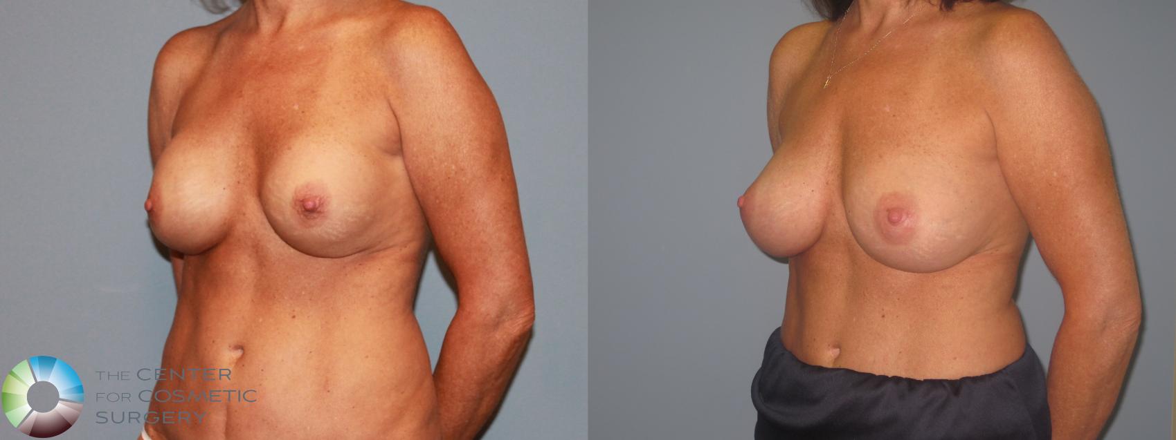Before & After Breast Implant Revision Case 713 View #4 View in Golden, CO