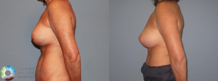 Before & After Breast Implant Revision Case 713 View #5 View in Golden, CO
