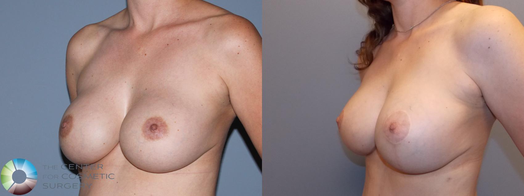 Before & After Breast Implant Revision Case 784 Left oblique in Denver and Colorado Springs, CO