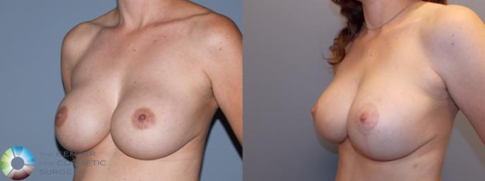 Before & After Breast Implant Revision Case 784 Left oblique in Denver and Colorado Springs, CO