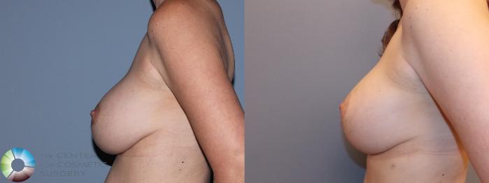 Before & After Breast Lift Case 784 Left side in Denver and Colorado Springs, CO