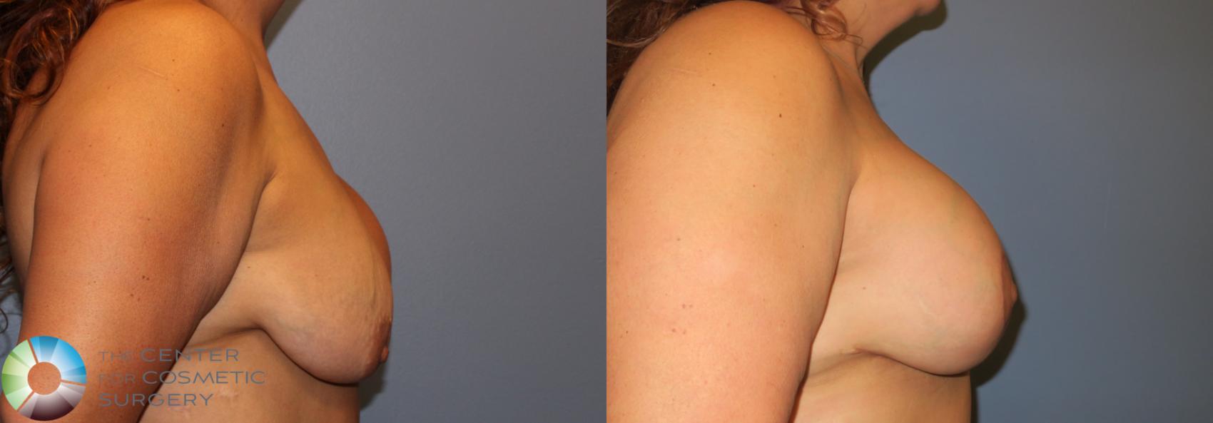 Before & After Breast Implant Revision Case 823 View #1 in Denver and Colorado Springs, CO