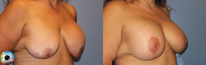 Before & After Breast Implant Revision Case 823 View #3 in Denver and Colorado Springs, CO