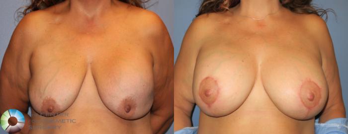 Before & After Breast Implant Revision Case 823 View #4 in Denver and Colorado Springs, CO
