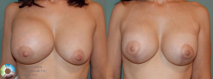 Before & After Breast Implant Revision Case 824 Anterior in Denver and Colorado Springs, CO