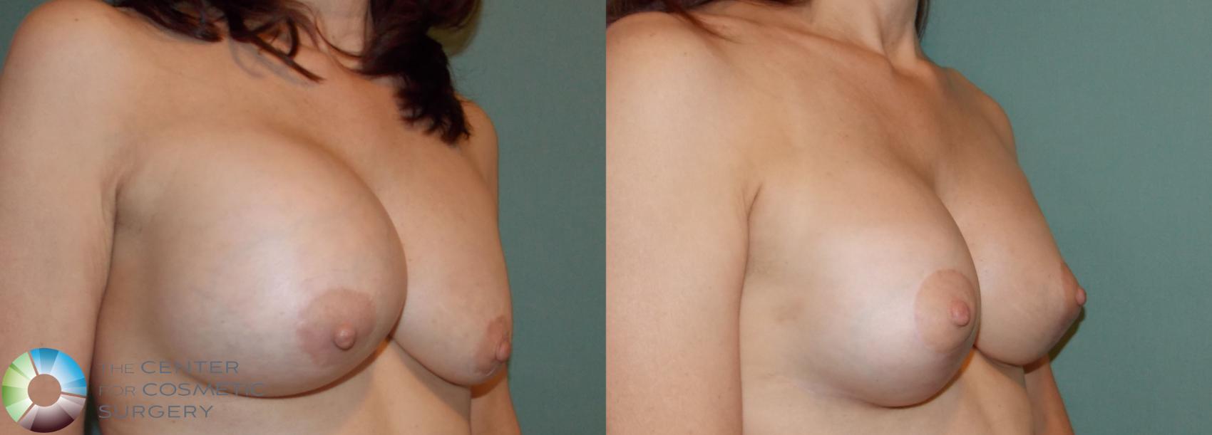 Before & After Breast Implant Revision Case 824 View #1 View in Golden, CO