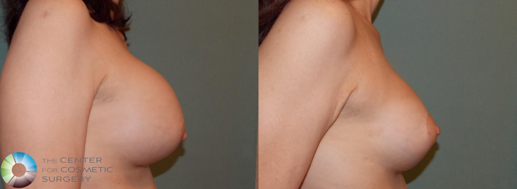 Before & After Breast Implant Revision Case 824 View #3 View in Golden, CO