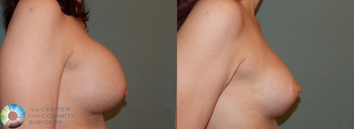 Before & After Breast Implant Revision Case 824 View #3 in Denver and Colorado Springs, CO