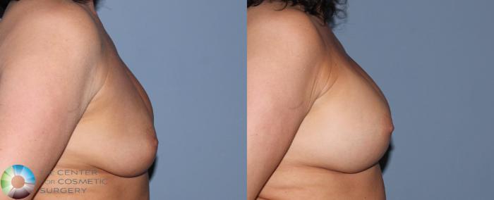 Before & After Breast Implant Revision Case 829 View #1 in Denver and Colorado Springs, CO