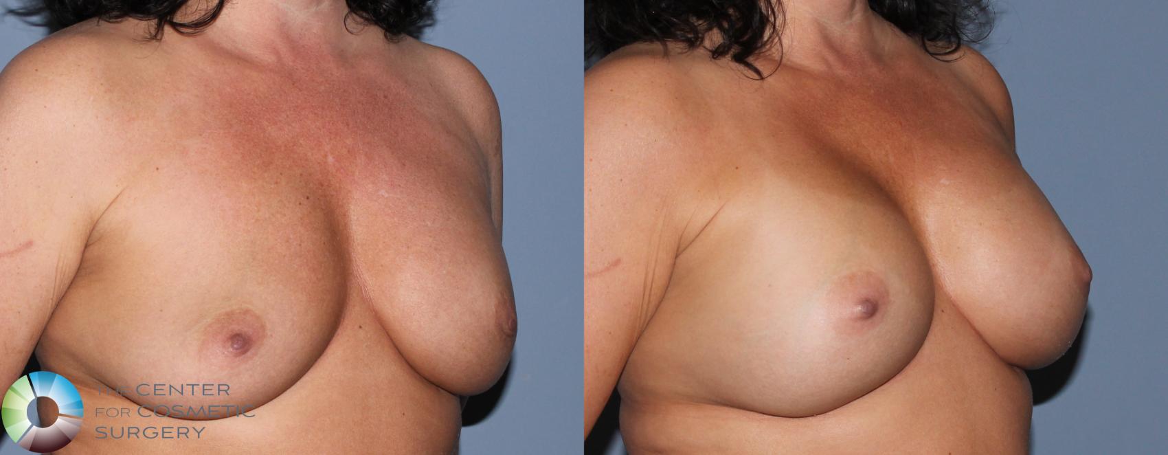 Before & After Breast Implant Revision Case 829 View #2 View in Golden, CO