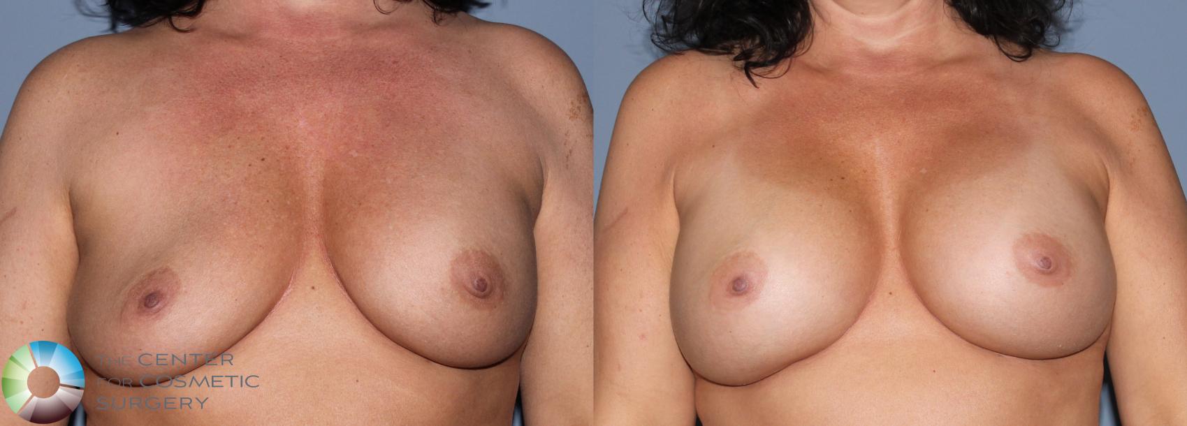 Before & After Breast Implant Revision Case 829 View #3 View in Golden, CO