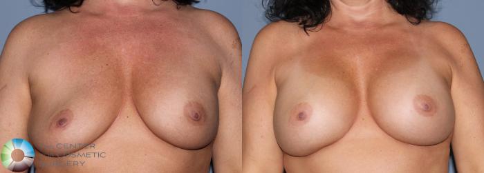 Before & After Breast Implant Revision Case 829 View #3 in Denver, CO