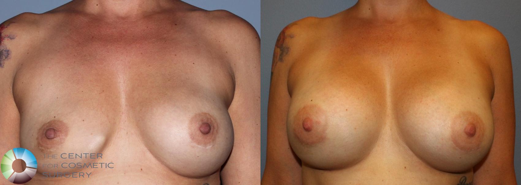 Before & After Breast Implant Revision Case 830 View #1 in Denver and Colorado Springs, CO