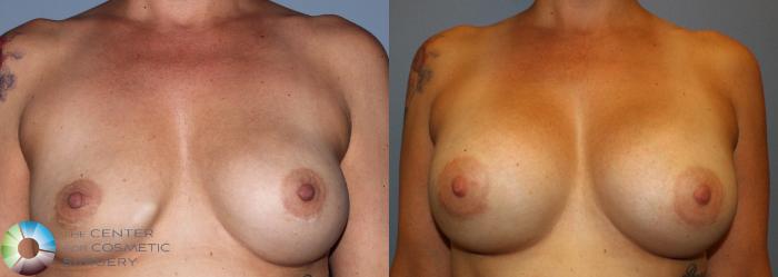Before & After Breast Implant Revision Case 830 View #1 in Denver and Colorado Springs, CO