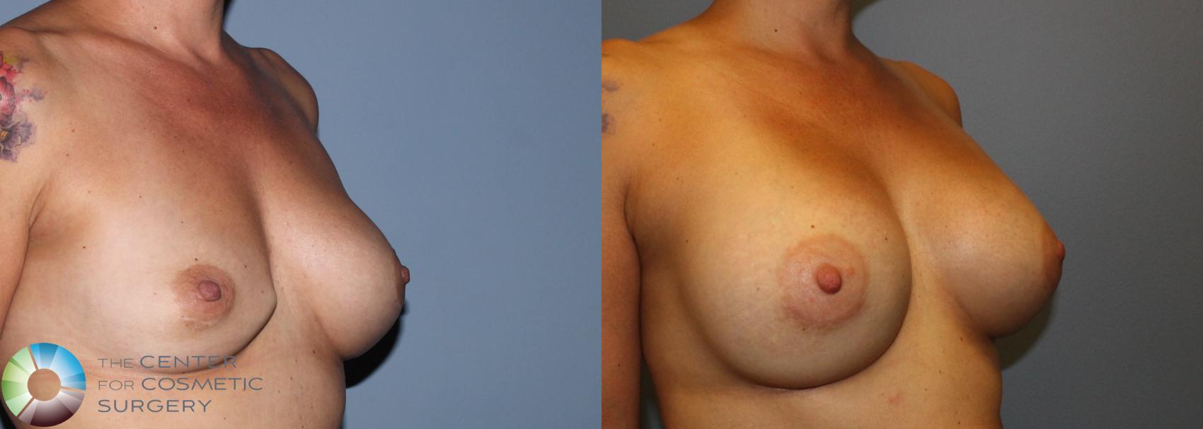 Before & After Breast Implant Revision Case 830 View #2 View in Golden, CO