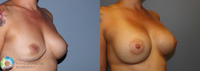 Before & After Breast Implant Revision Case 830 View #2 in Denver and Colorado Springs, CO