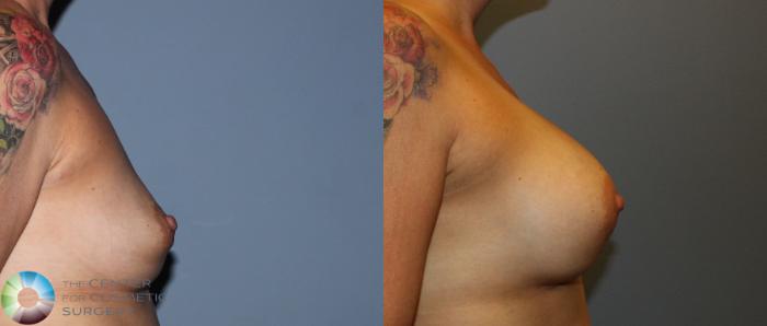 Before & After Breast Implant Revision Case 830 View #3 in Denver and Colorado Springs, CO