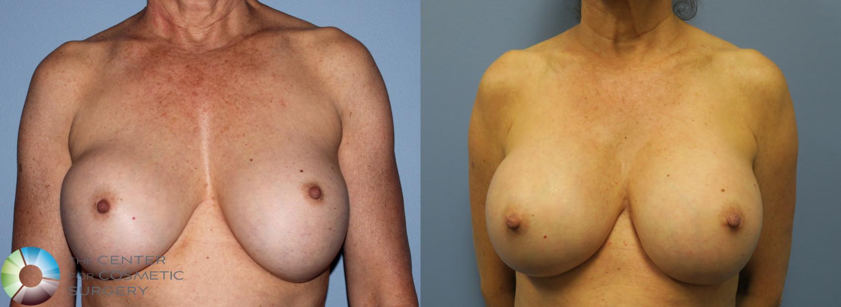 Before & After Breast Implant Revision Case 831 View #1 in Denver and Colorado Springs, CO