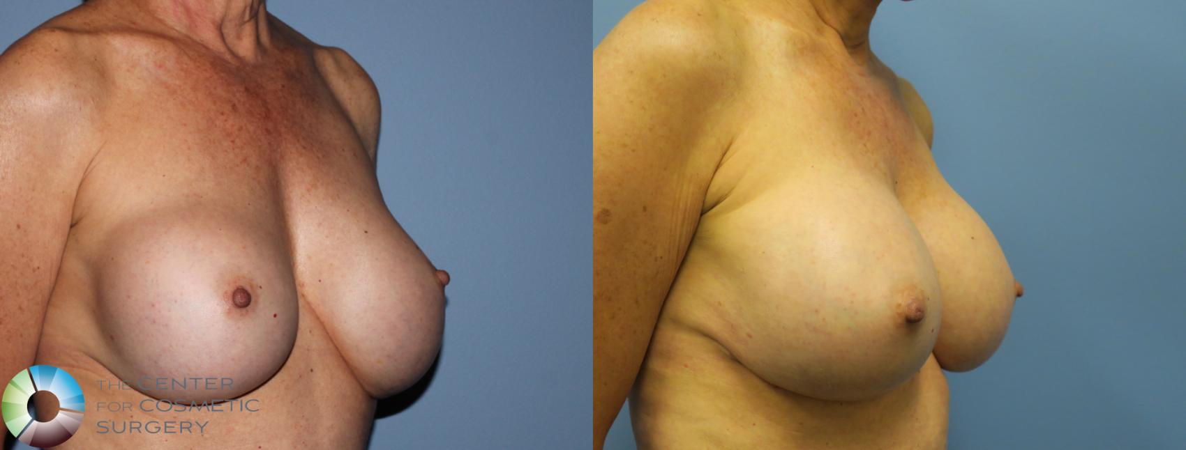 Before & After Breast Implant Revision Case 831 View #2 View in Golden, CO