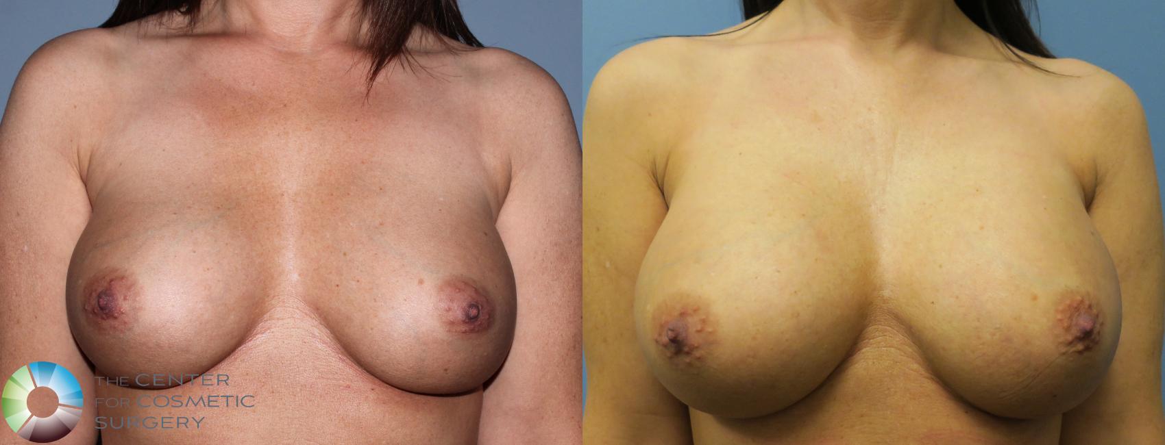 Before & After Breast Implant Revision Case 835 View #1 in Denver and Colorado Springs, CO