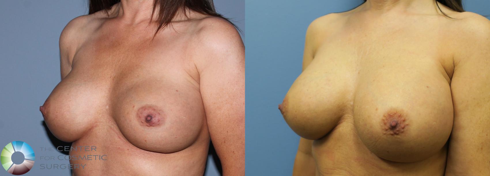 Before & After Breast Implant Revision Case 835 View #2 in Denver and Colorado Springs, CO