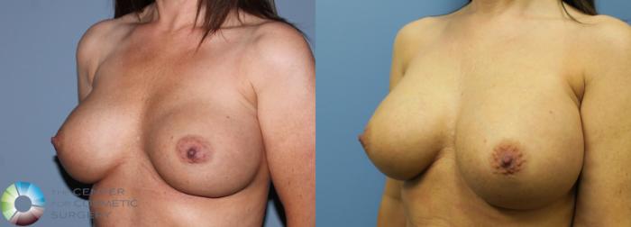 Before & After Breast Implant Revision Case 835 View #2 View in Golden, CO