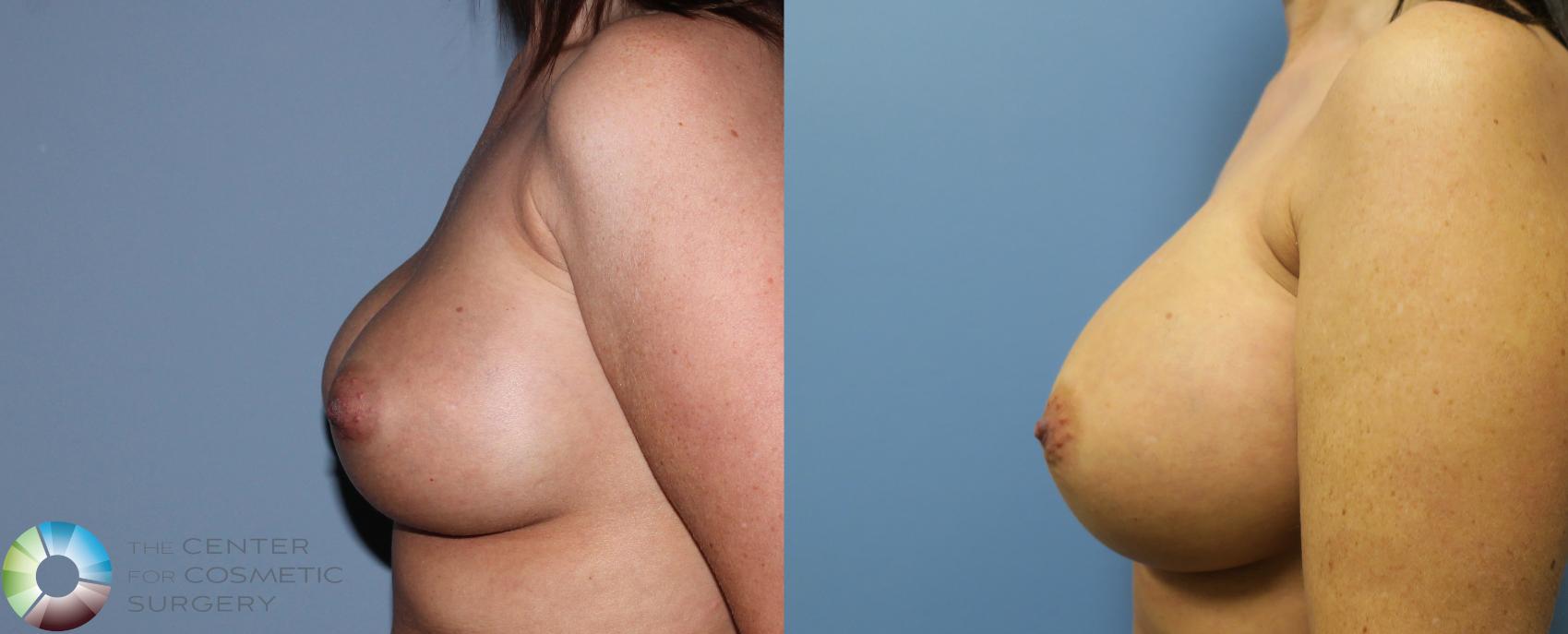 Before & After Breast Implant Revision Case 835 View #3 in Denver and Colorado Springs, CO