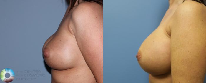 Before & After Breast Implant Revision Case 835 View #3 View in Golden, CO
